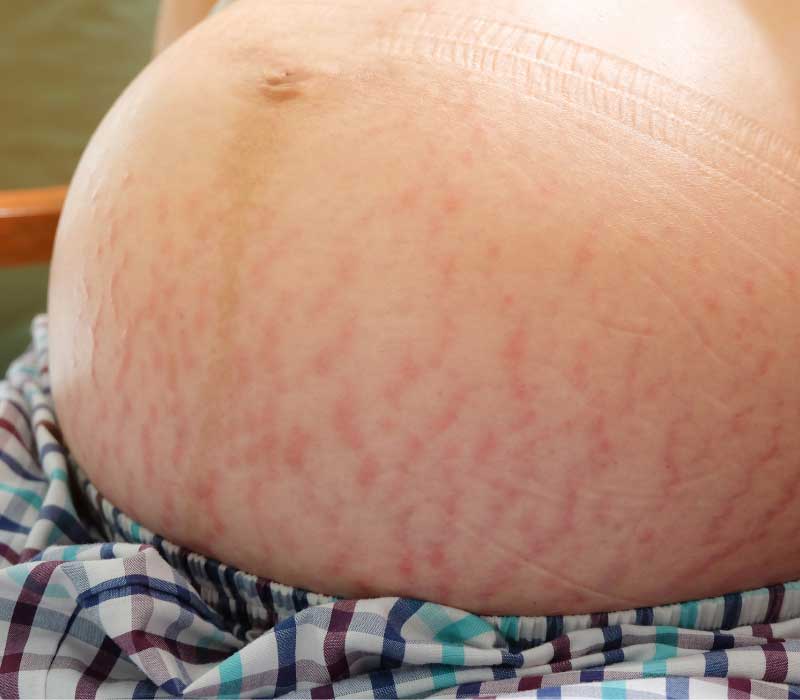 strije u trudnoći na stomaku