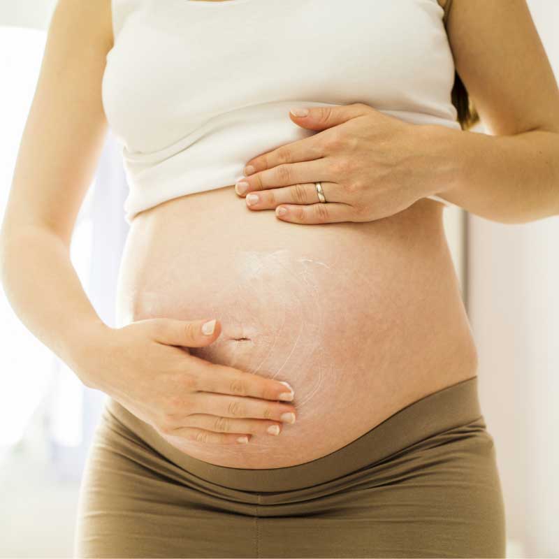 sprečavanje strija u trudnoći